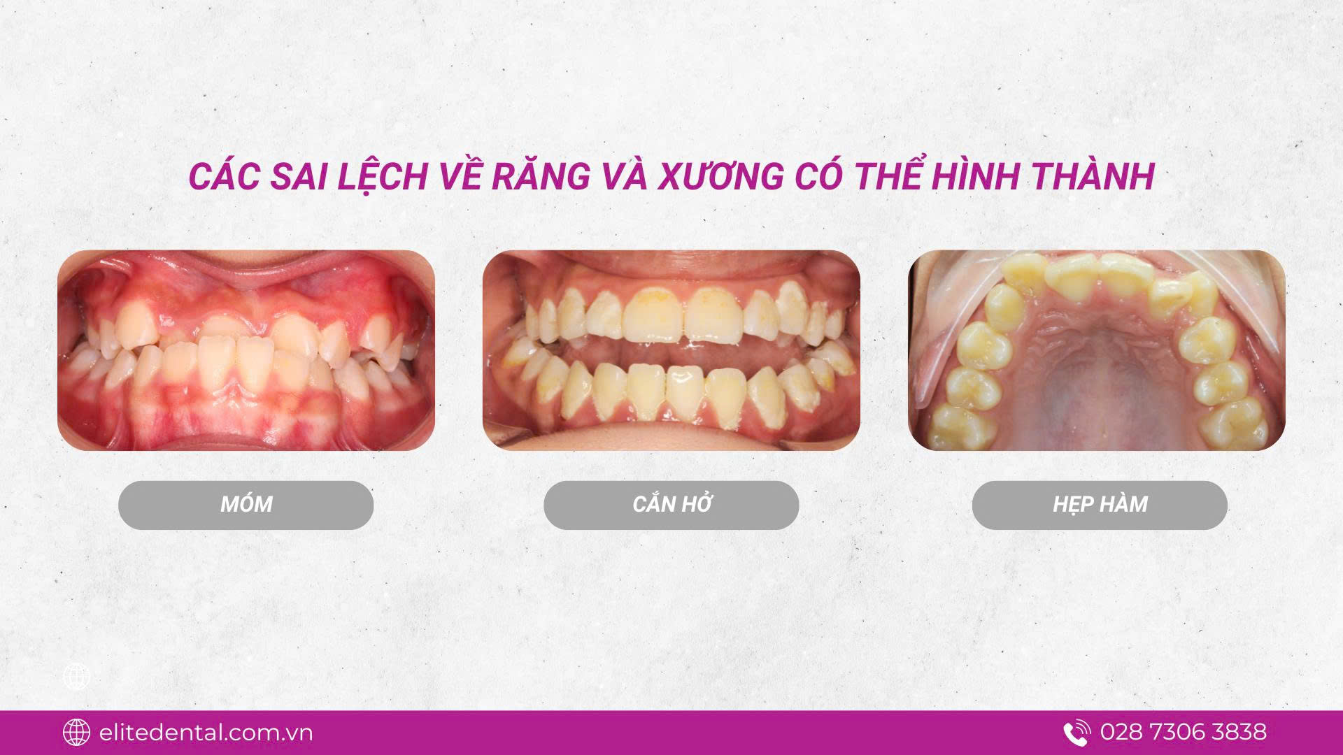 Các sai lệch về răng và xương có thể hình thành
