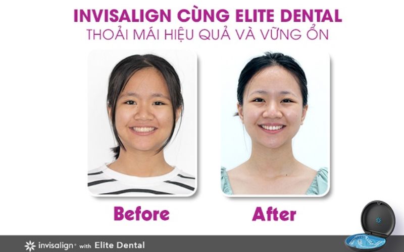Kết quả chỉnh nha của khách hàng là minh chứng rõ nhất cho chất lượng dịch vụ của Elite Dental