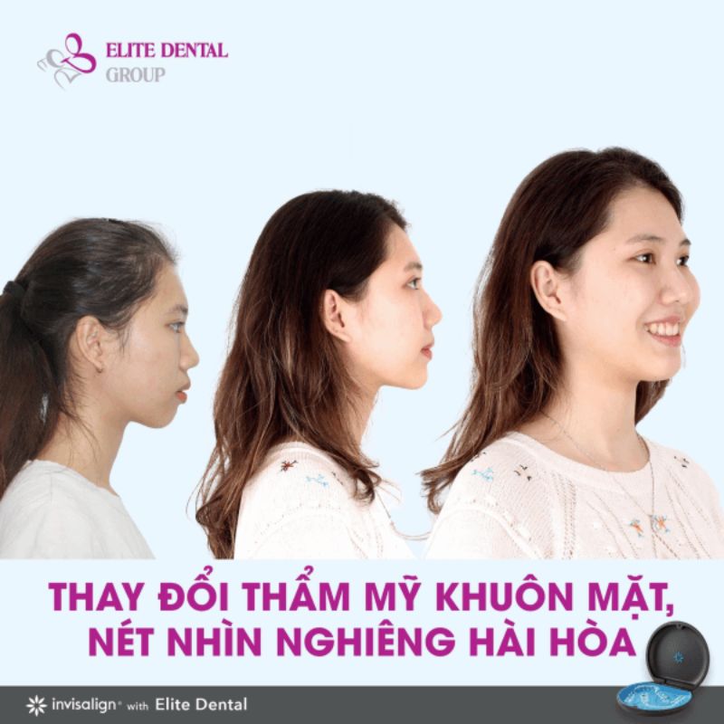 Thay đổi thẩm mỹ khuôn mặt bằng phương pháp niềng răng Invisalign