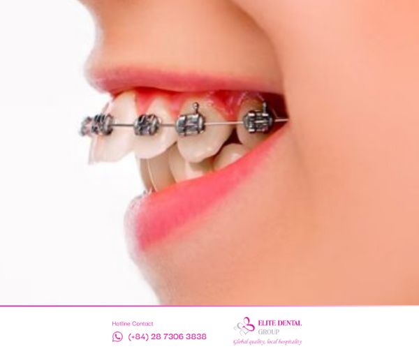 Niềng răng hô chính là giải pháp giúp bạn tự tin hơn với vẻ ngoài của mình