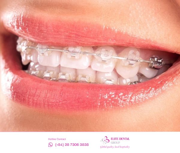 Bạn nên can thiệp điều chỉnh răng hô càng sớm càng tốt để tránh bỏ lỡ giai đoạn vàng