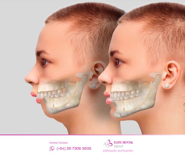 Răng hô gây mất thẩm mỹ và ảnh hưởng đến khớp cắn