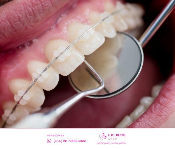 Người bệnh nên tìm đến trung tâm chỉnh nha uy tín – nơi có đội ngũ Bác sĩ giàu chuyên môn, vững tay nghề, với thao tác thực hiện khéo léo, nhẹ nhàng.