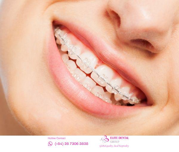 Mắc cài sứ cải thiện chức năng ăn nhai, phục hình nụ cười rạng rỡ và gương mặt cân đối.