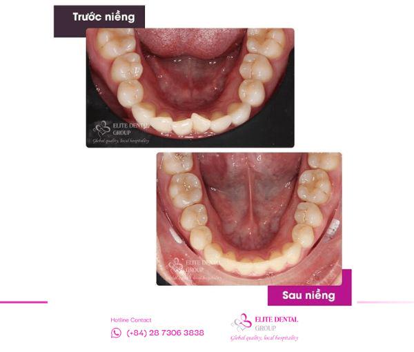 Hình ảnh niềng răng mắc cài sứ.