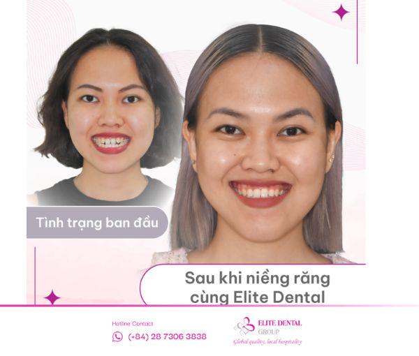 Kết thúc hành trình chỉnh nha tại Elite, T.N đã nâng cấp hoàn chỉnh cho nụ cười của mình đầy tươi tắn rạng rỡ.