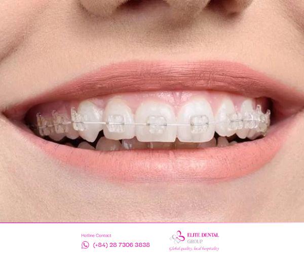 Hình ảnh niềng răng mắc cài sứ cho thấy vật liệu có màu sắc gần với răng thật, góp phần nâng cao nụ cười thẩm mỹ, tự nhiên và tinh tế.