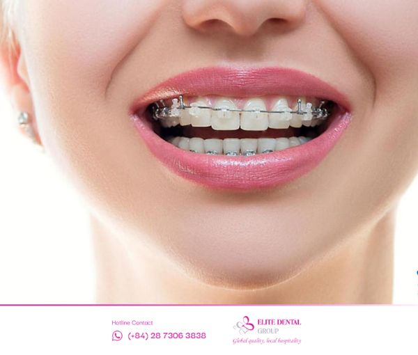 Niềng răng mắc cài sứ tự buộc giúp tăng tính thẩm mỹ và tạo sự tự tin cho bạn