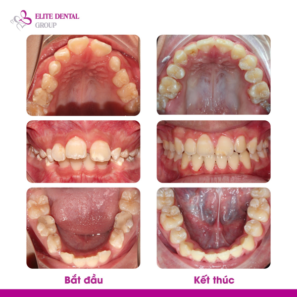 Trước và sau niềng răng hô trẻ em.