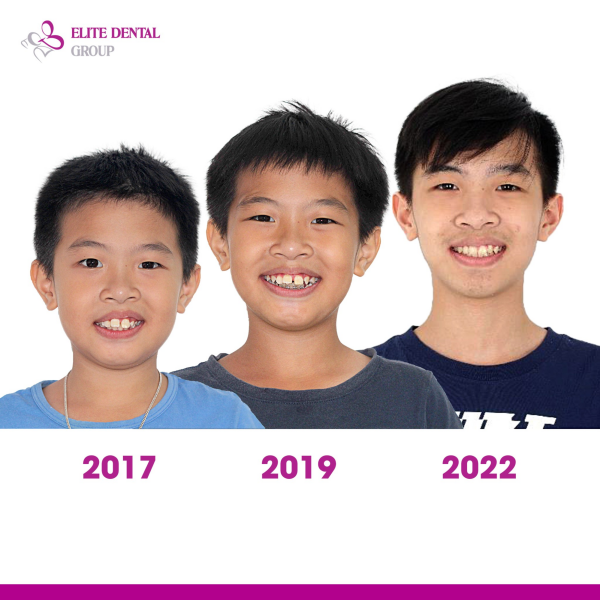 Niềng răng hô trẻ em