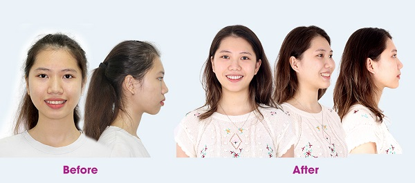 Trước và sau khi niềng răng hô.