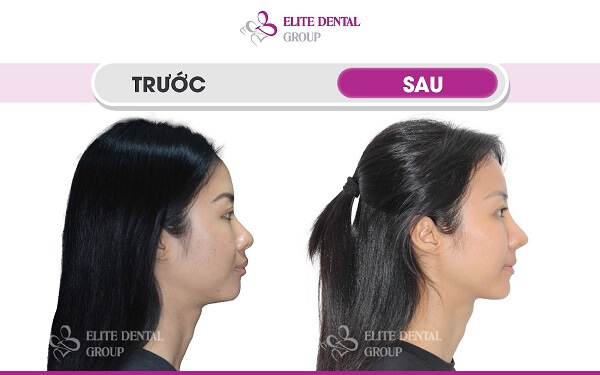 Trải nghiệm niềng răng tại Elite Dental