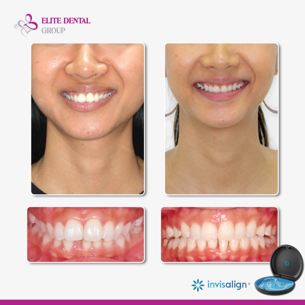 Niềng răng để có hàm răng đẹp khỏe