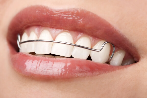 Đeo hàm duy trì giúp đảm bảo hiệu quả của chỉnh nha
