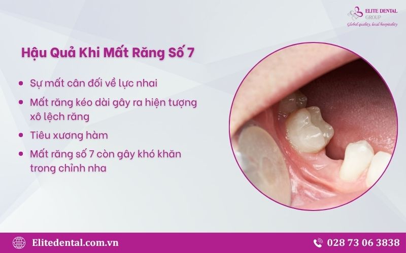 Hậu quả của việc mất răng số 7