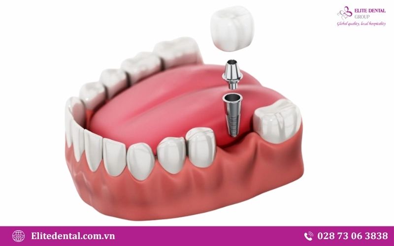 Khắc phục tình trạng mất răng số 7 bằng phương pháp cấy ghép Implant