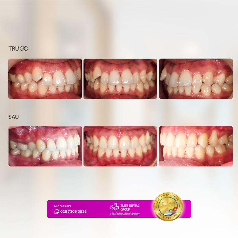 Răng được sắp xếp thẳng hàng trước và sau khi niềng răng