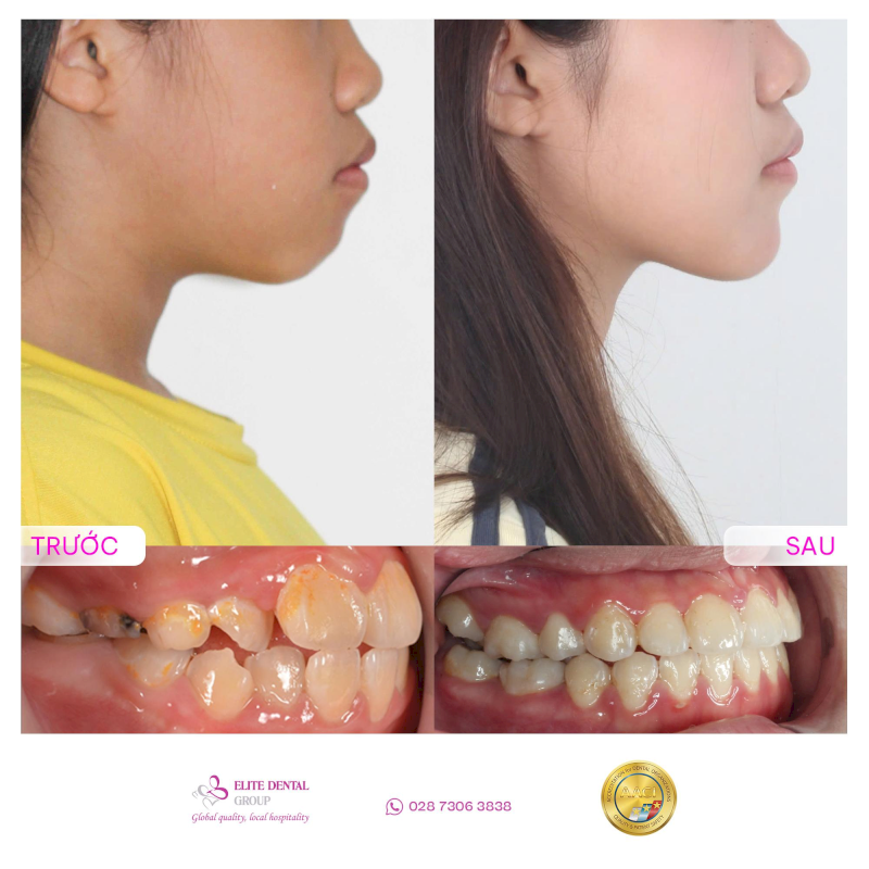 Chỉnh nha tại Elite Dental giúp mang lại góc nghiêng thanh thoát hơn