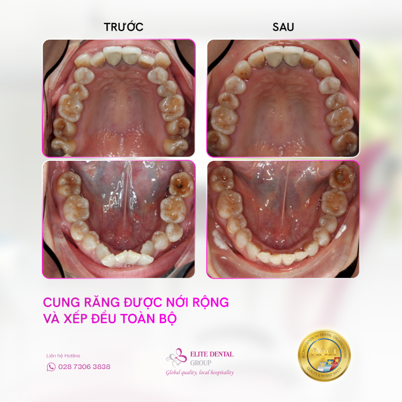 Răng được sắp xếp đều giúp vệ sinh răng dễ dàng hơn
