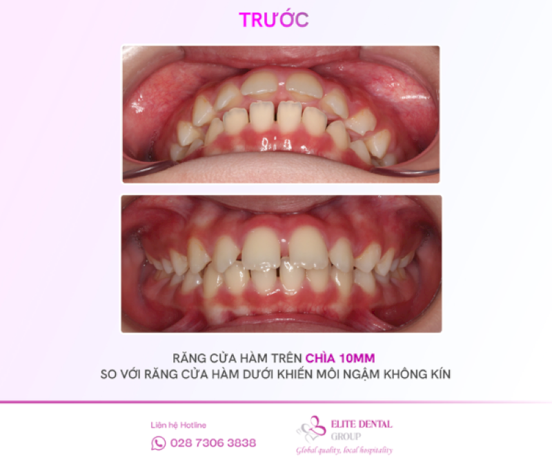 Răng chìa, hô dễ có nguy cơ gây chấn thương