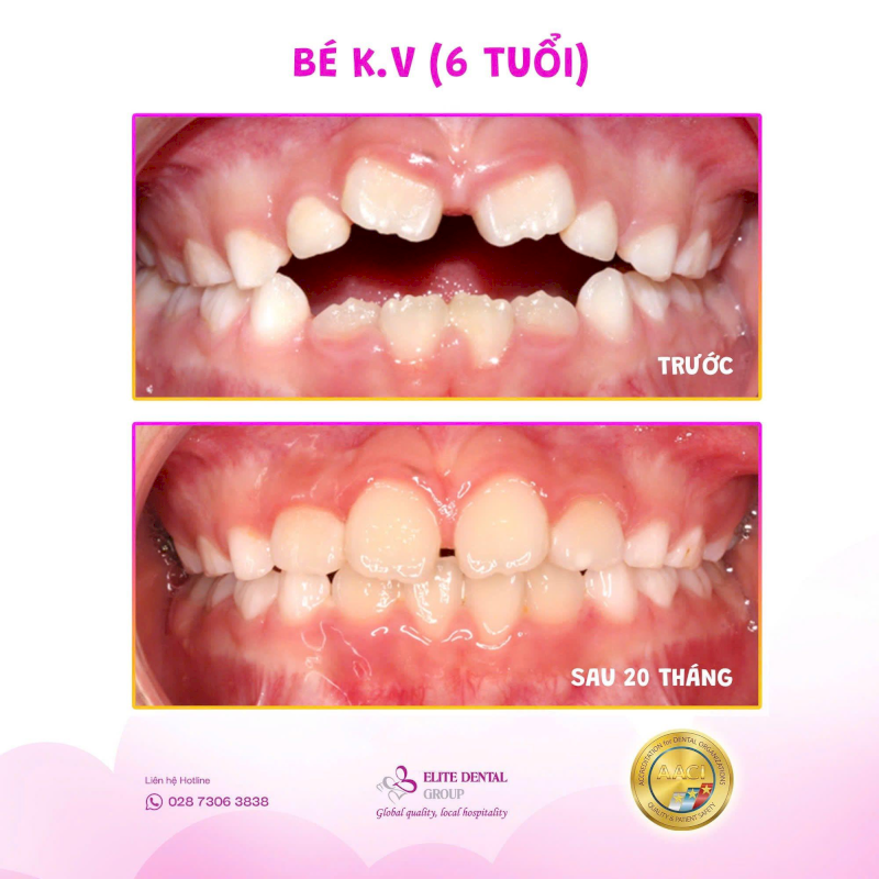 Niềng răng giúp cải thiện tình trạng thở miệng gây hô răng, lùi cằm ở trẻ
