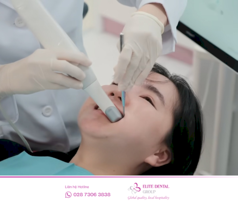 Hệ thống công nghệ kỹ thuật số máy CBCT máy scan Trios và ClinCheck tại Elite Dental