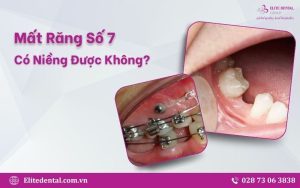 Mất răng số 7 có niềng được không là vấn đề nhiều bệnh nhân quan tâm khi có nhu cầu niềng răng