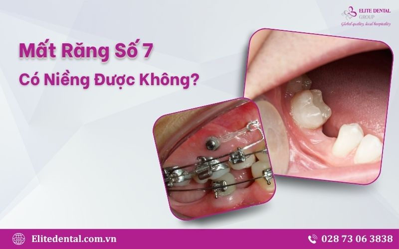Mất răng số 7 có niềng được không là vấn đề nhiều bệnh nhân quan tâm khi có nhu cầu niềng răng