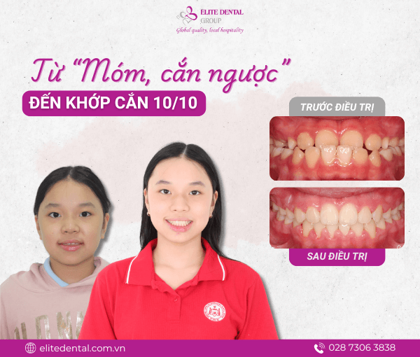 Niềng răng giúp nâng cao tính thẩm mỹ và đảm bảo chức năng ăn nhai