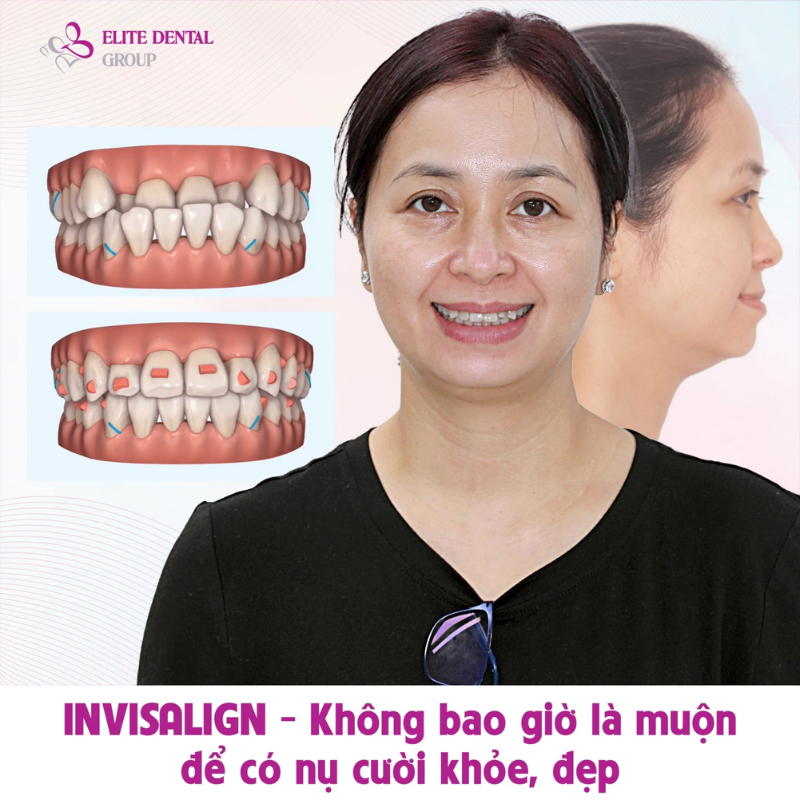 Ca niềng răng móm bằng phương pháp niềng răng trong suốt tại Elite Dental