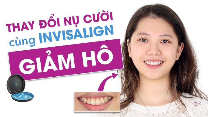 Thay đổi nụ cười bằng phương pháp niềng răng trong suốt Invisalign