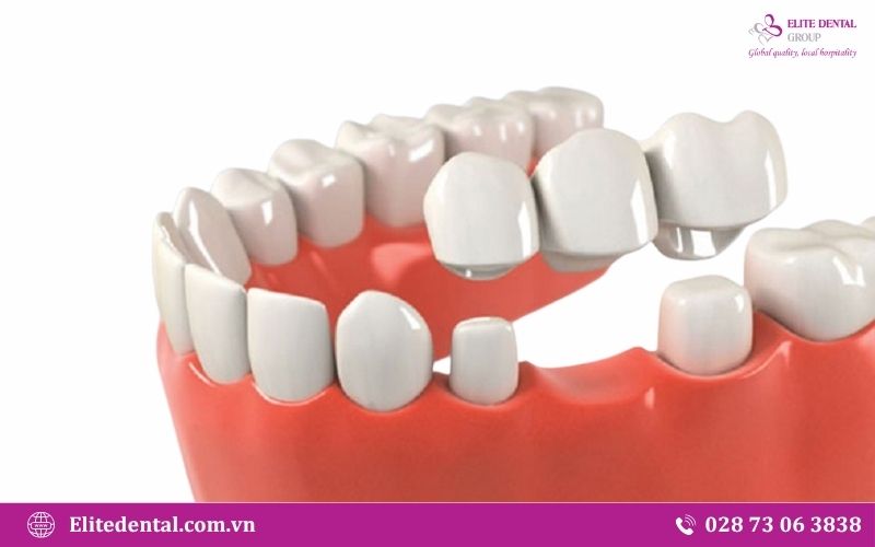 Áp dụng phương pháp bắc cầu để khắc phục tình trạng mất răng số 7