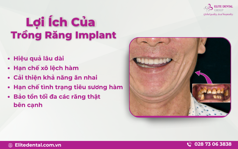 Tại sao người lớn tuổi nên trồng răng để khắc phục tình trạng mất răng?