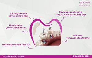 60 có nên niềng răng