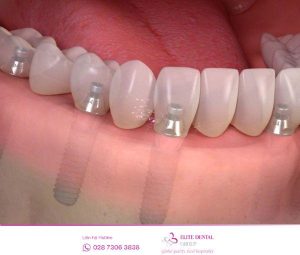 Biến chứng trồng răng