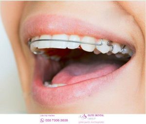 ham-duy-tri-sau-chinh-nha-deo-bao-lau