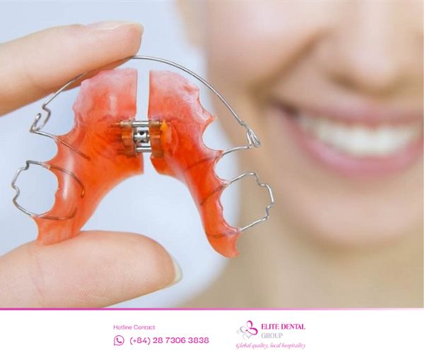 Nong hàm hỗ trợ quá trình sắp xếp răng được dễ dàng