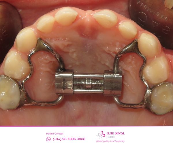 Nong hàm là một kỹ thuật chỉnh nha phổ biến hiện nay