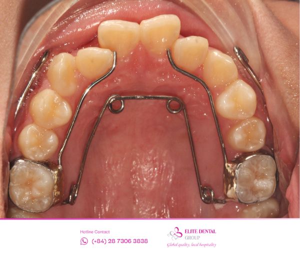 Khí cụ nong hàm Quad Helix, giúp nới rộng chậm, đảm bảo sinh lý