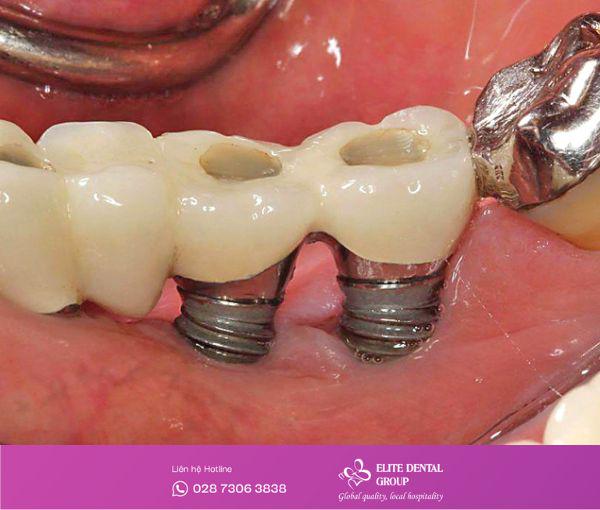 Răng implant