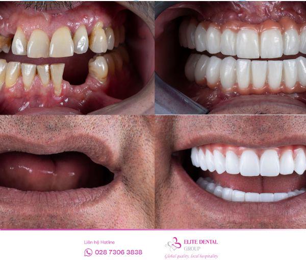 Những trường hợp nào nên trồng răng toàn hàm?