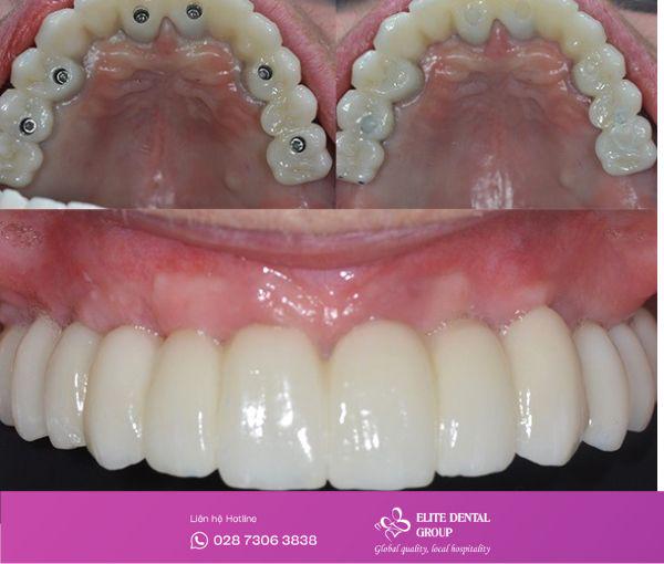 Trồng răng toàn hàm tại Elite Dental – Giải pháp toàn diện cho người mất răng.