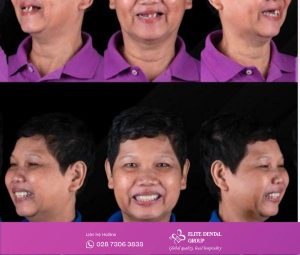 Trồng răng toàn hàm