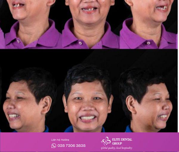 Trồng răng toàn hàm