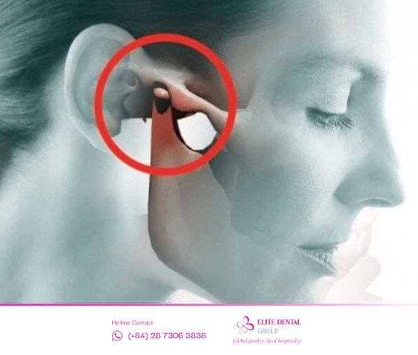 Viêm khớp thái dương cần được chẩn đoán và điều trị kịp thời