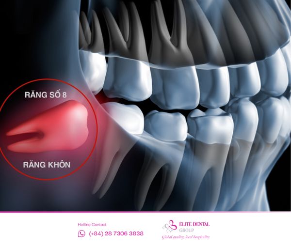 Răng khôn mọc lệch cũng là nguyên nhân dẫn đến viêm khớp thái dương