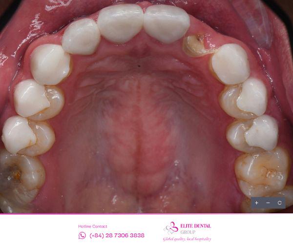 Hình ảnh gãy răng ngang chỉ còn chân răng của anh Kye