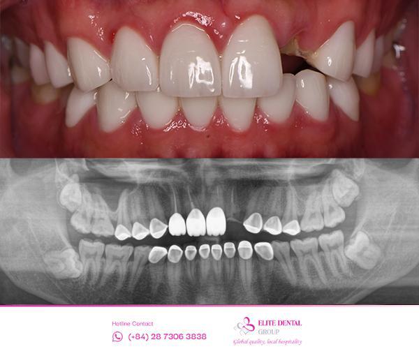 Hình ảnh trước điều trị của anh Kye tại Elite Dental