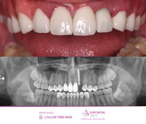 Hình ảnh sau điều trị của anh Kye tại Elite Dental
