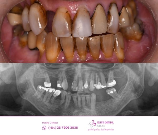 Trước và sau điều trị răng